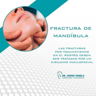 Fractura de Mandíbula