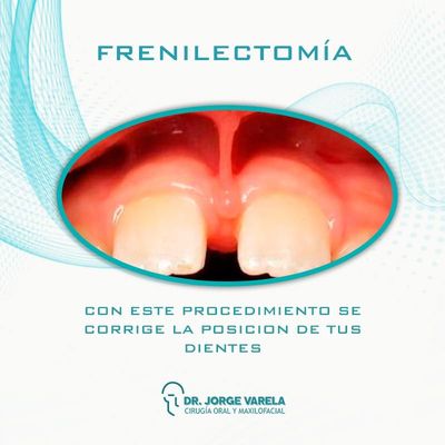 Frenilectomía