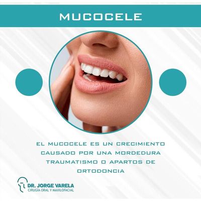 Mucocele