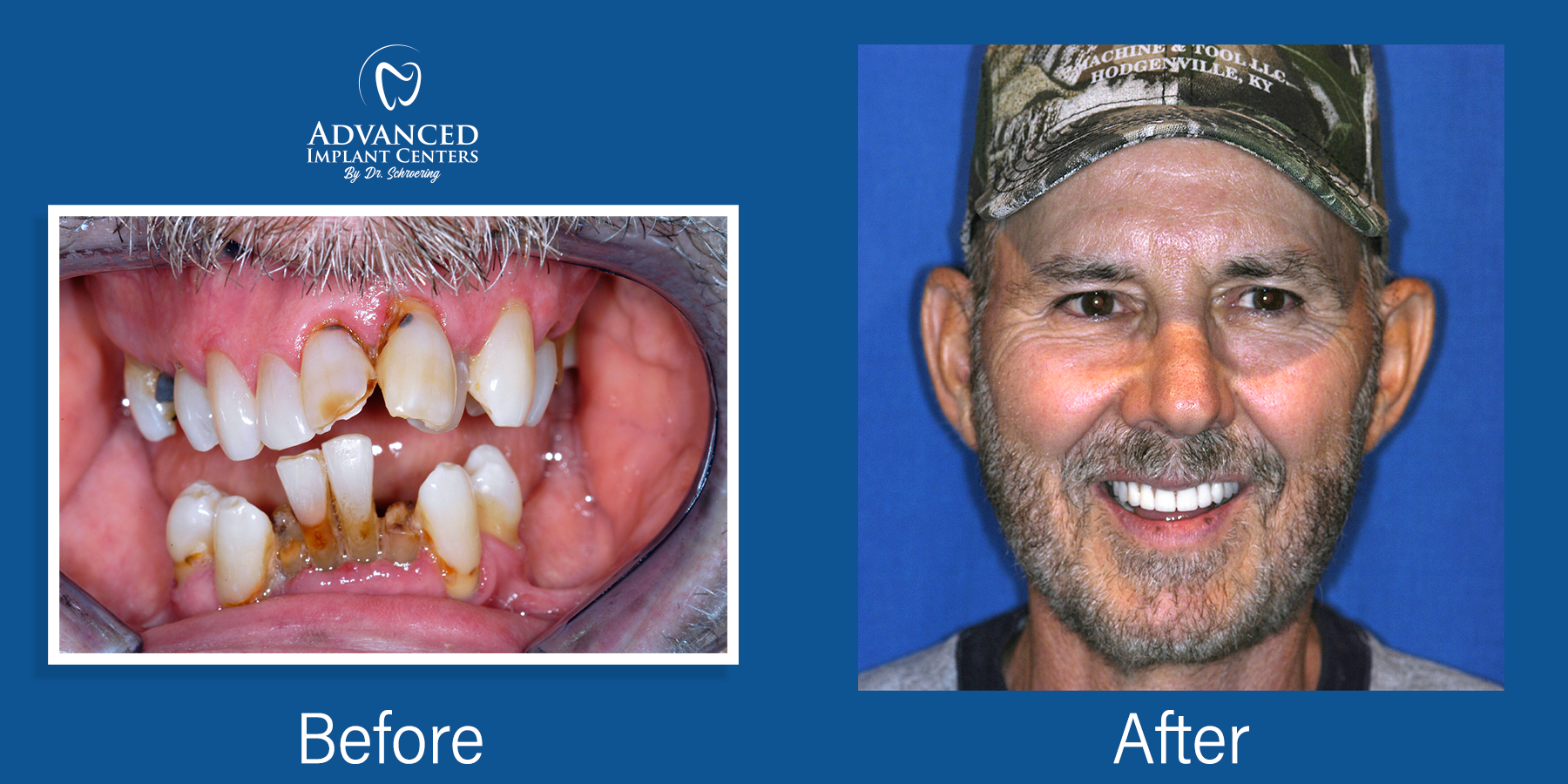 Dental Implants Marion, IN & Louisville, KY 5022684840
