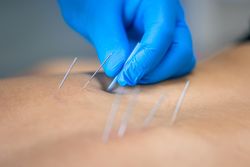 Gloved hand inserting acupuncture needles into skin, close-up on treatment site