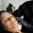 Gloved hand inserting acupuncture needles into skin, close-up on treatment site
