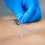 Gloved hand inserting acupuncture needles into skin, close-up on treatment site