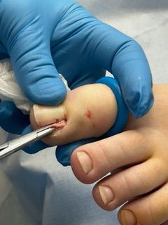 image showing removal of ingrown toenail