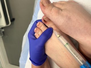 Local anaesthetic before Treatment