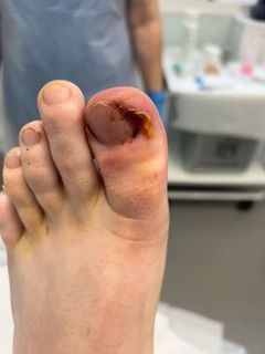 Ingrown Toenail before treatment