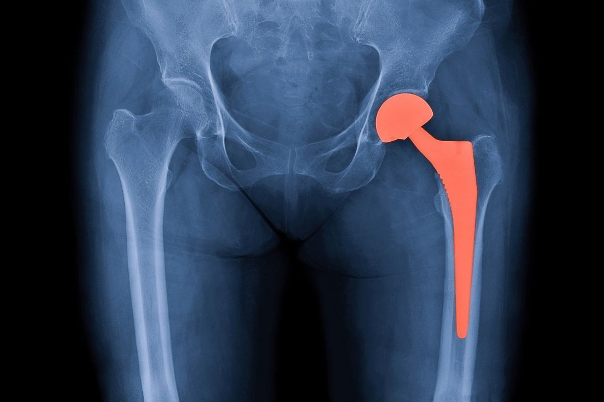 dr-ricardo-kirihara-ortopedista-artroplastia-quadril-sao-paulo