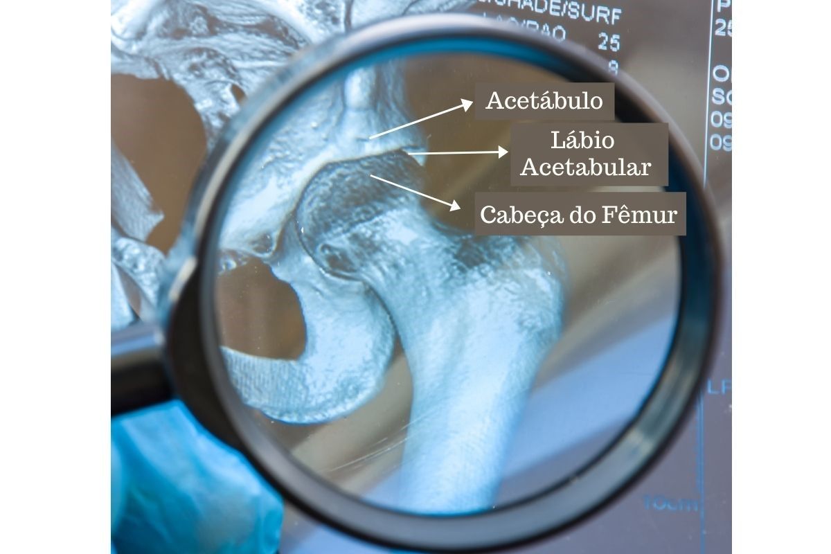 issura-labral-causas-dr-ricardo-kirihara-ortopedista-quadril-sao-paulo