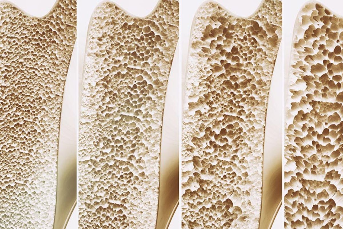 osteopenia-doi-causas-dr-ricardo-kirihara-ortopedista-quadril-sao-paulo