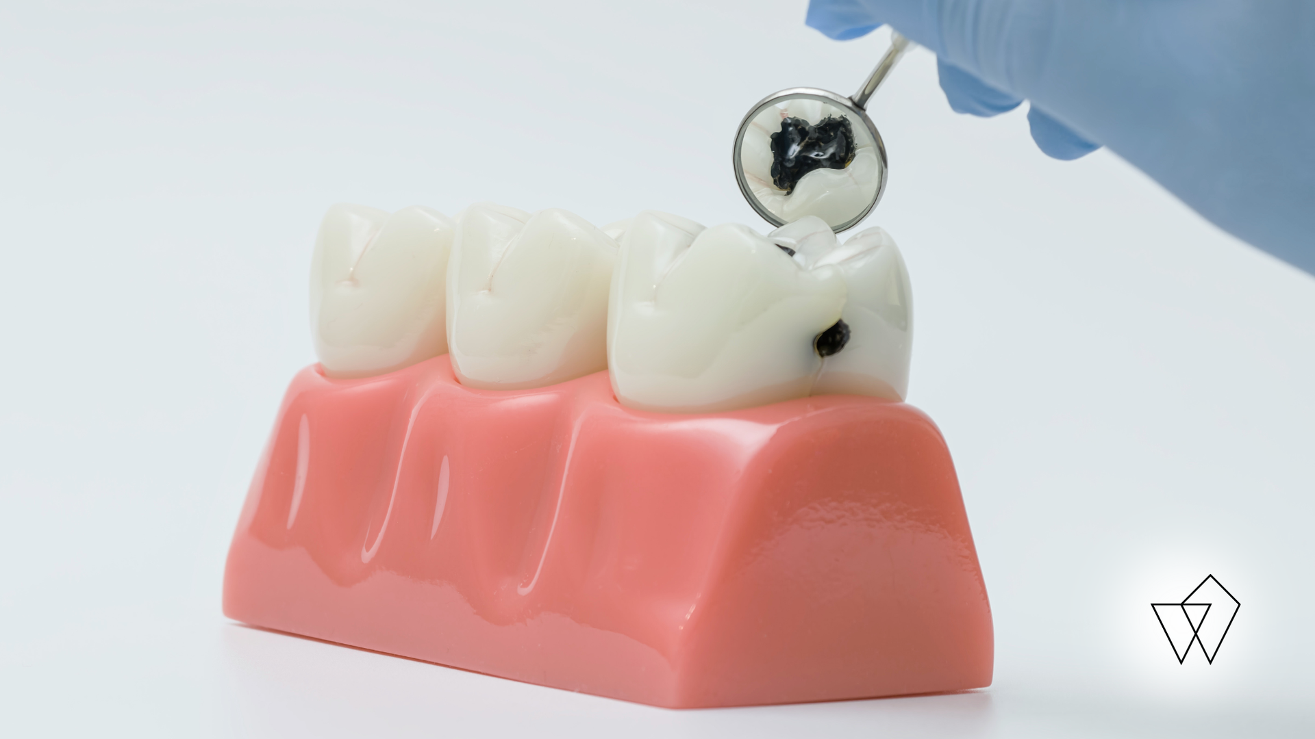 Dental model with tooth being treated by a drill, held by a blue-gloved hand
