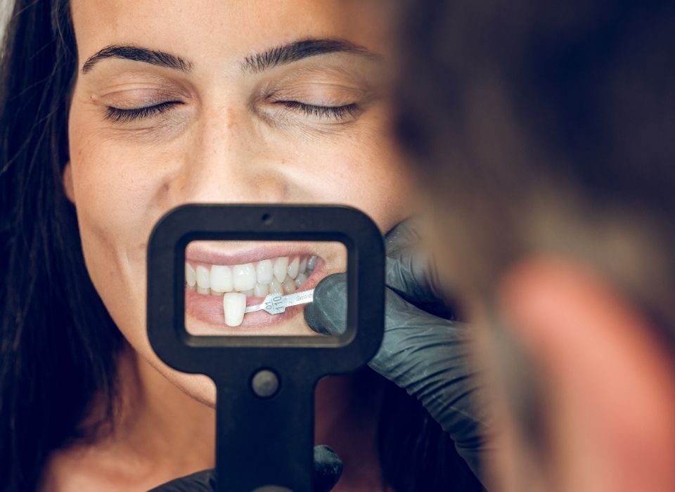 Side-by-side comparison of stained and whitened teeth, showing improved whiteness and brightness.