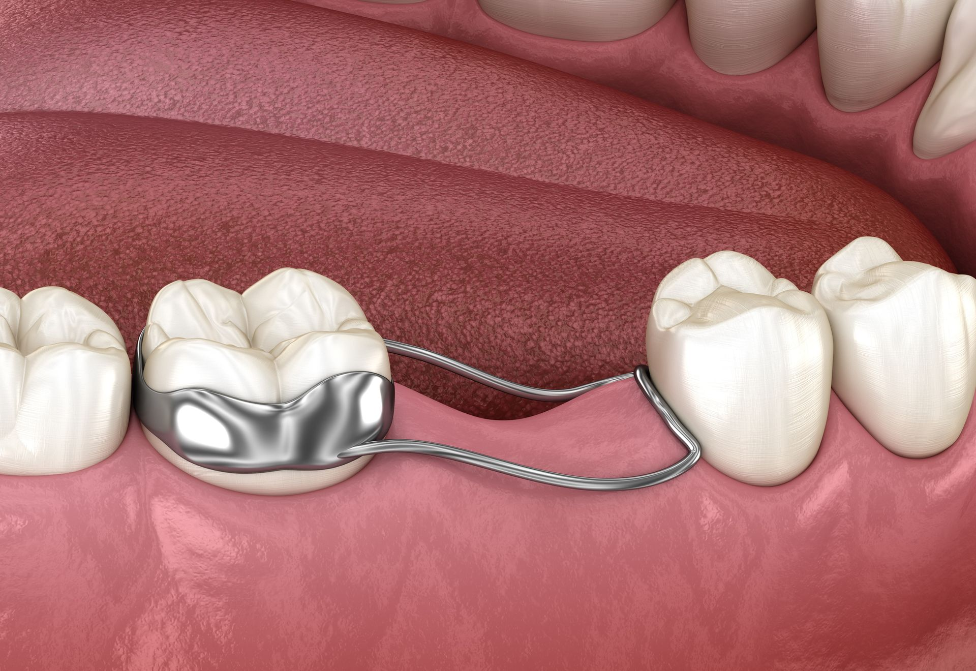 Dental retainer holding space for a missing tooth; metal band and wire in mouth.