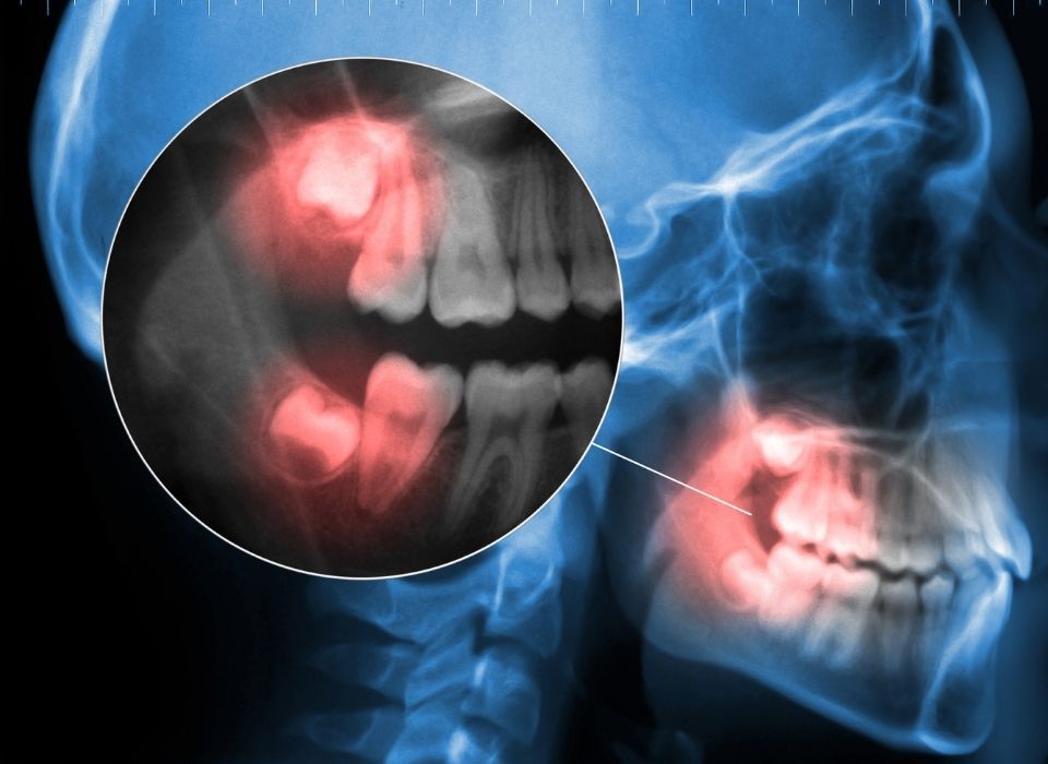 X-ray of a human jaw highlighting impacted wisdom teeth, with areas of inflammation marked in red.