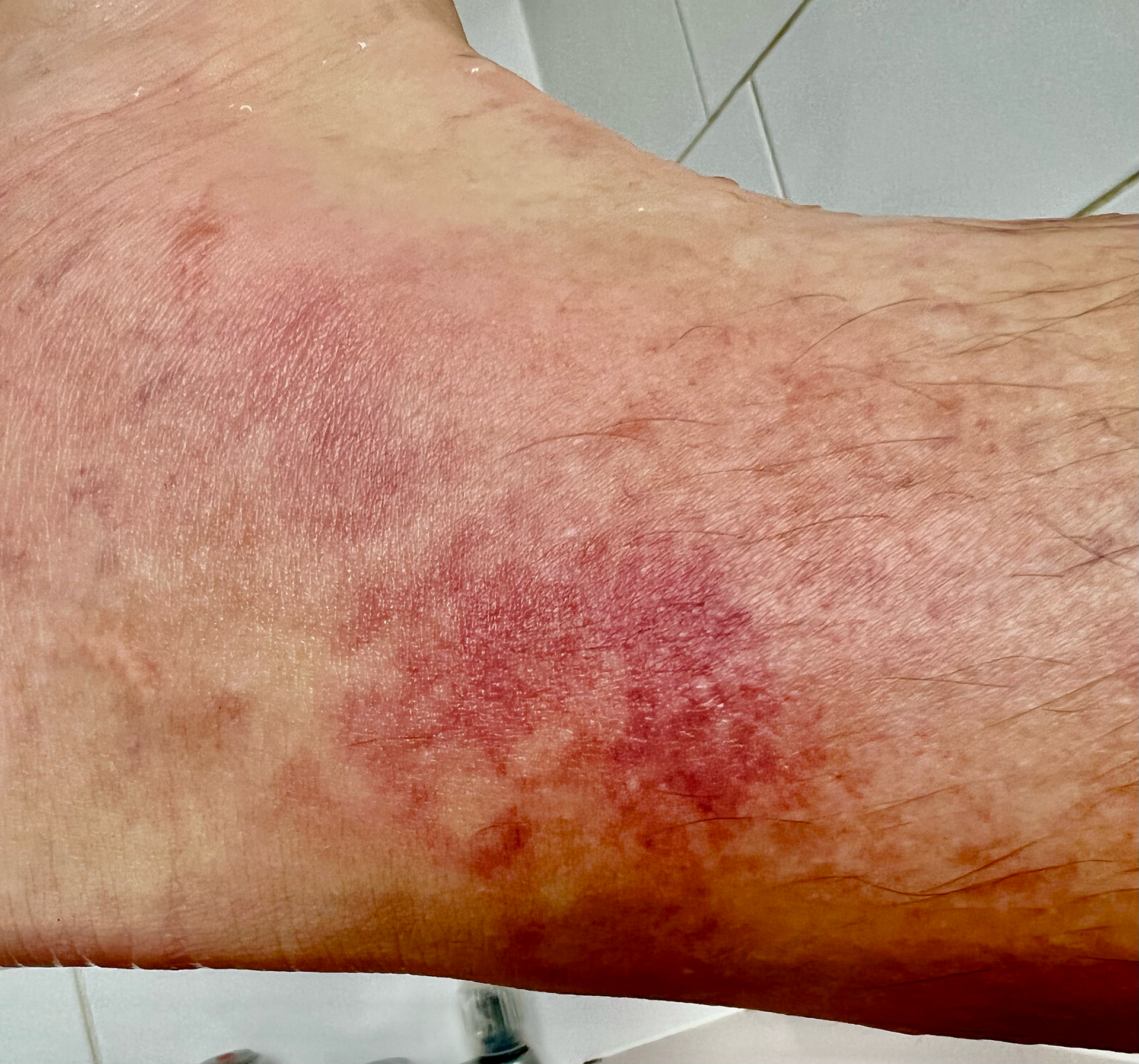 bumble bee sting from Bombus hypnorum on the ankle of adult male, Bristol, UK