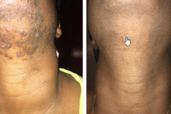 A before and after photo of a woman with acne on her neck