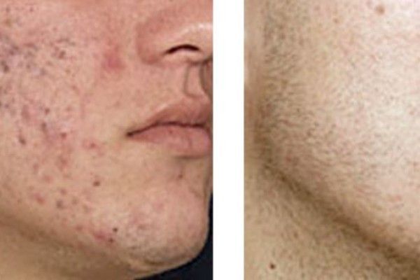 A before and after picture of a man 's face with acne.