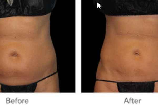 A before and after picture of a woman 's stomach