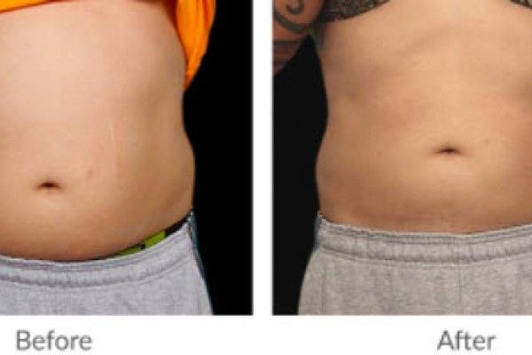 A before and after picture of a man 's stomach.