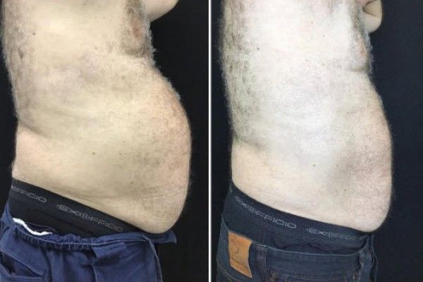 A before and after picture of a man 's stomach.
