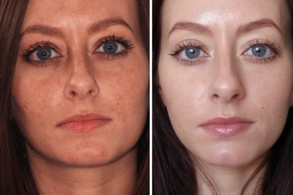 A before and after photo of a woman 's face