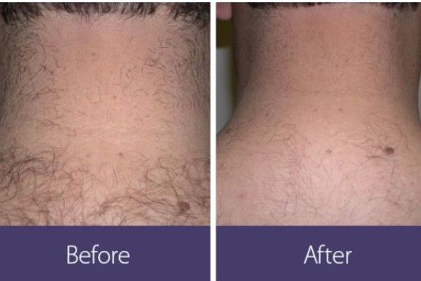 A before and after picture of a man 's neck