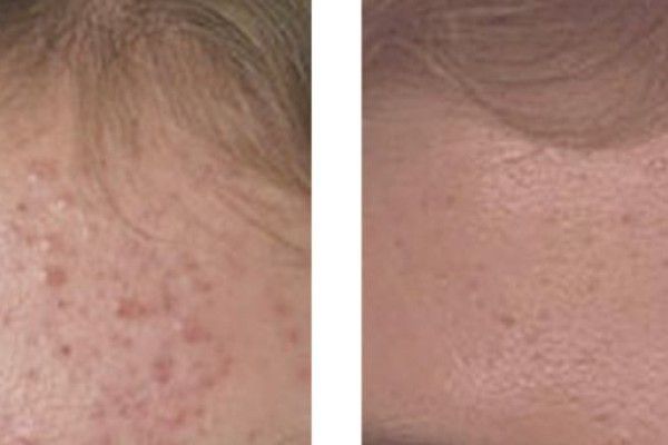 A before and after photo of a woman 's face with acne.