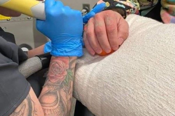 A person is getting a tattoo removed from their arm.