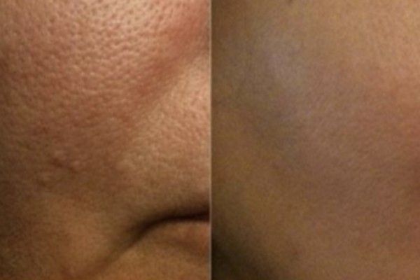 A before and after picture of a person 's face with a lot of pores.