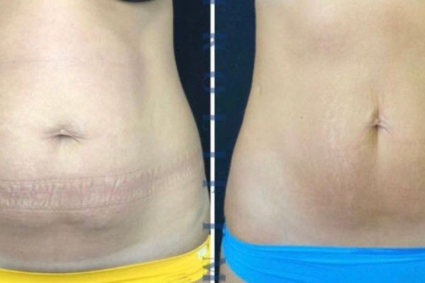 A woman 's stomach is shown before and after surgery.