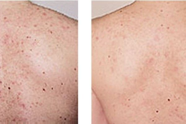 A before and after picture of a person 's back with acne.
