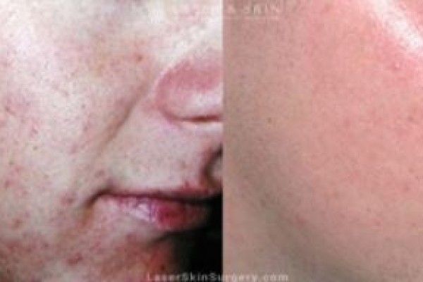 A before and after photo of a woman 's face