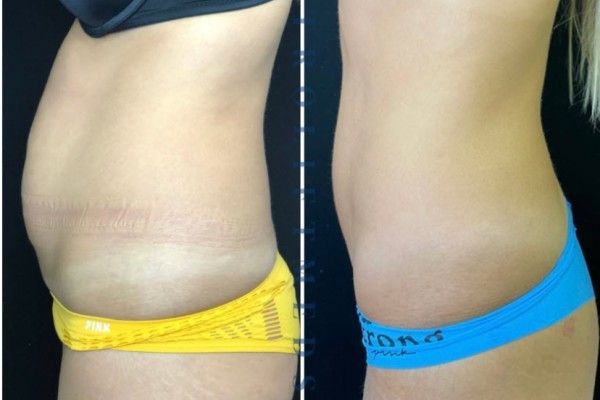 A before and after photo of a woman 's stomach