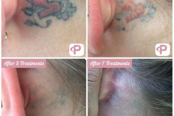 A before and after photo of a woman 's ear with a tattoo on it.