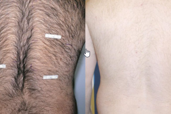 A before and after picture of a person 's back
