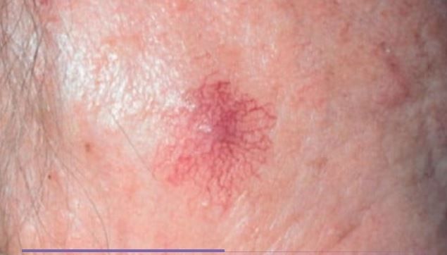 A close up of a person 's skin with a red spot on it