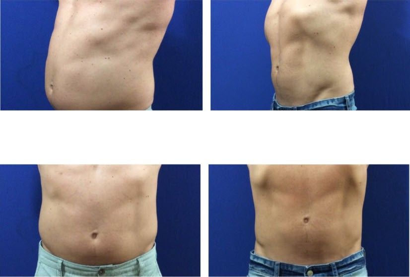 A before and after picture of a man 's stomach