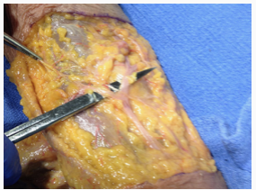 Gloved hand injecting a syringe into a person's upper arm close-up