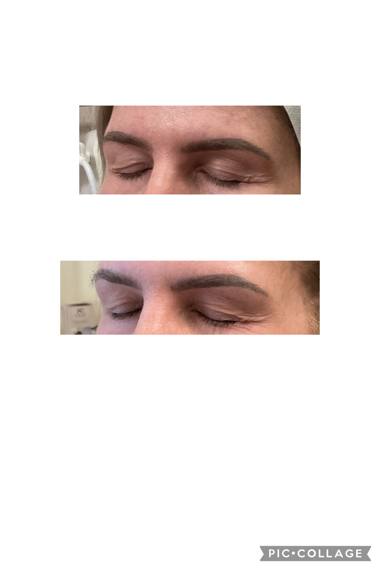 Two close-up photos of closed eyes with bruising and dark discoloration around the eyelids.