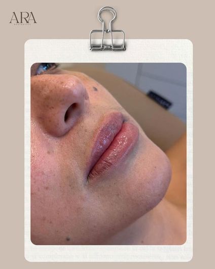 Close-up of a person’s lower face with lip injections
