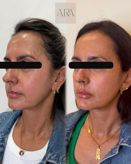 Side-by-side facial profile photos of a woman before and after cosmetic treatment.