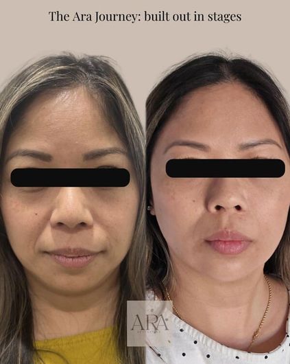 Side-by-side before-and-after facial photos with the caption “The Ara Journey: built out in stages.”
