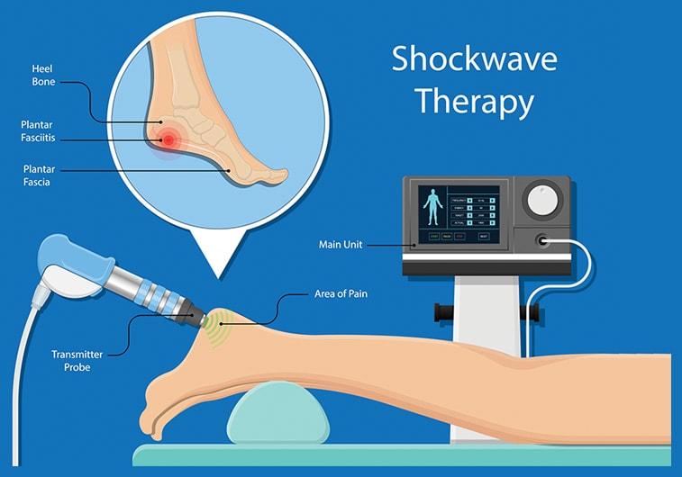 Shockwave therapy for plantar fasciitis: 