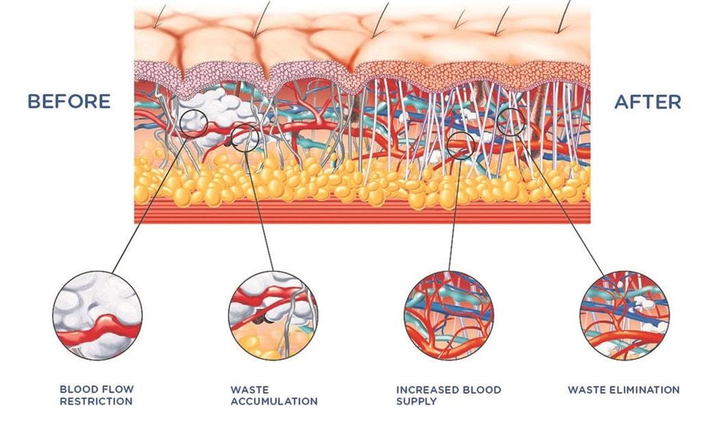 Cross-section comparing skin tissue before and after treatment, showing improved blood flow and reduced swelling.