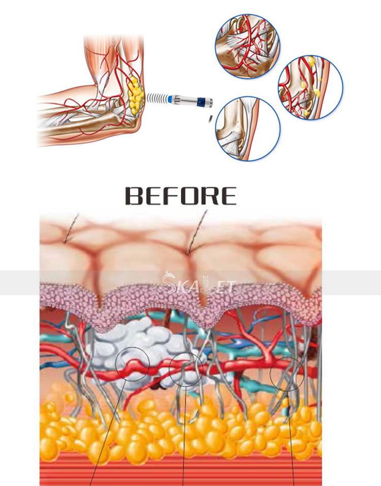 Medical illustration of an elbow injection procedure. Skin layers before injection, blood vessels highlighted.