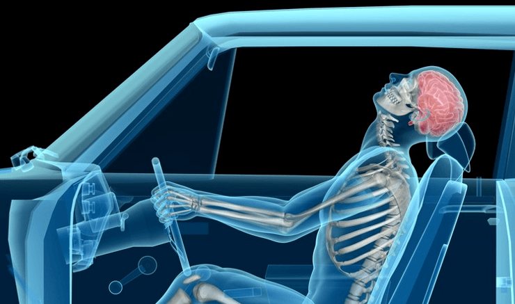 X-ray view of a person in a car, head thrown back, with brain visible; driving a car.