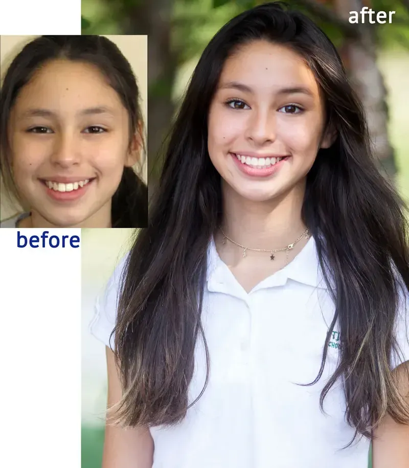 Before/after photos of a girl smiling, her teeth straightened. She is wearing a white shirt, with long dark hair.