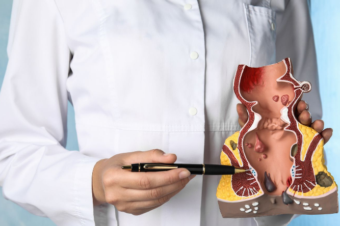 Hemorrhoid-Banding