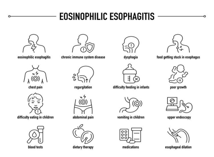 eosinophilic-esophagitis symptoms and causes chart