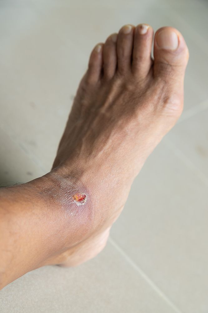Diabetic Wounds