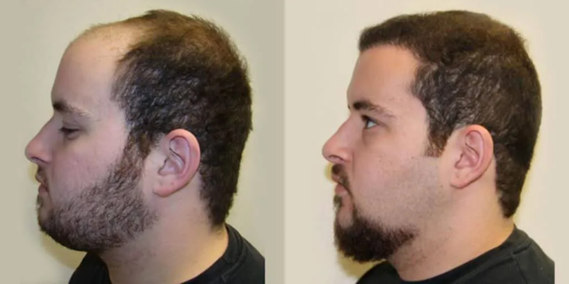 Side-by-side profile photos of a bearded man before and after a haircut, showing longer and shorter hair. Side-by-side profile photos of a bearded man before and after a haircut, showing longer and shorter hair.